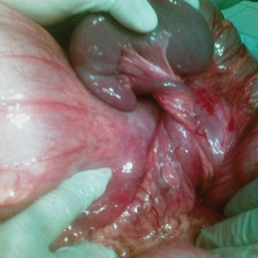 Green arrow – Splenic pedicle. Red arrow – Spleen fixed in retroperitoneal position. Courtesy Dr. V. Penopoulos.