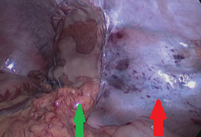 Green arrow – Splenic pedicle. Red arrow – Spleen fixed in retroperitoneal position. Courtesy Dr. V. Penopoulos.