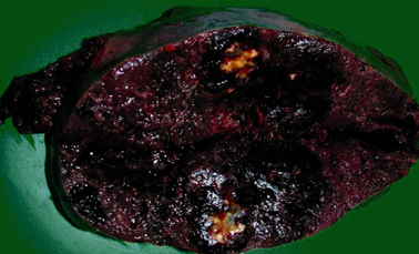 The enlarged spleen in cross-section – dark-colored, soft and elastic consistency, measuring 21 x 13 x 9 cm. Courtesy Dr. V. Penopoulos.