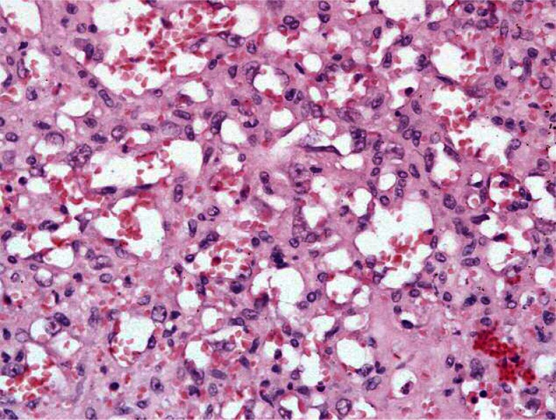 Presence of abundant large, atypical cells. Courtesy Dr. V. Penopoulos.