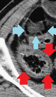 Αξονική τομογραφία οπισθοπεριτοναίου. Κίτρινα βέλη – Αμφοτερόπλευρη διάταση ουρητήρων. Ευγενική παραχώρηση Dr. V. Penopoulos.