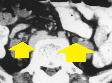 Εξερευνητική λαπαροσκόπηση – Διατεταμένες, οιδηματώδεις έλικες λεπτού εντέρου με εστιακές περιοχές ισχαιμίας. Ευγενική παραχώρηση Dr. V. Penopoulos.
