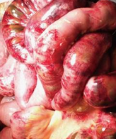 α) Νεκρωτική αγγειίτιδα. Διατοίχωμα φλεγμονή του αγγειακού τοιχώματος, με ή χωρίς ινοειδή νέκρωση. β) Νεκρωτική αγγειίτιδα μεσεντερικής αρτηρίας, με παναρτηριακή νέκρωση και παρουσία ινοειδούς νέκρωσης αγγειακού τοιχώματος. Ευγενική παραχώρηση Dr. V. Penopoulos.