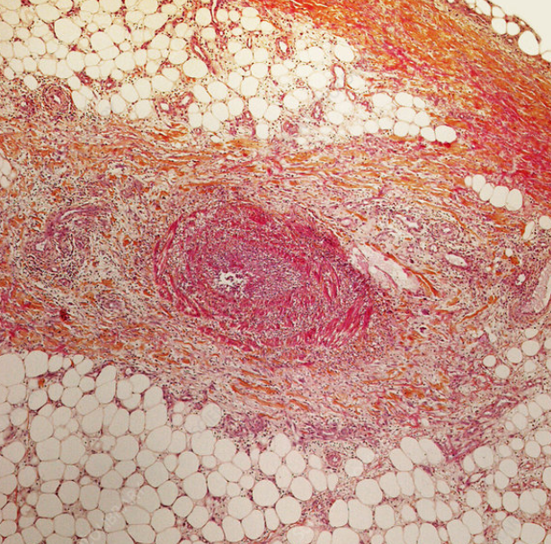 Εξερευνητική λαπαροτομία – Πολλαπλές διατρήσεις σε άλλο ασθενή με οζώδη πολυαρτηρίτιδα. Ευγενική παραχώρηση Dr. V. Penopoulos.