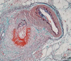 Εξερευνητική λαπαροτομία – Πολλαπλές διατρήσεις σε άλλο ασθενή με οζώδη πολυαρτηρίτιδα. Ευγενική παραχώρηση Dr. V. Penopoulos.