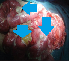 Εξερευνητική λαπαροτομία – Πολλαπλές διατρήσεις σε άλλο ασθενή με οζώδη πολυαρτηρίτιδα. Ευγενική παραχώρηση Dr. V. Penopoulos.