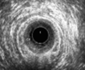 Ενδοπρωκτικό υπερηχογράφημα – Πλήρης υποχώρηση νεοπλάσματος πρωκτού. Ευγενική παραχώρηση Dr. V. Penopoulos.