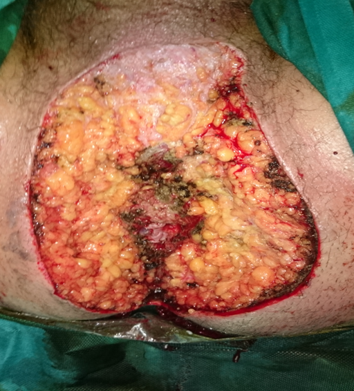 Μακροσκοπική εμφάνιση περινέου μετά από ριζική τοπική εκτομή. Ευγενική παραχώρηση Dr. V. Penopoulos.