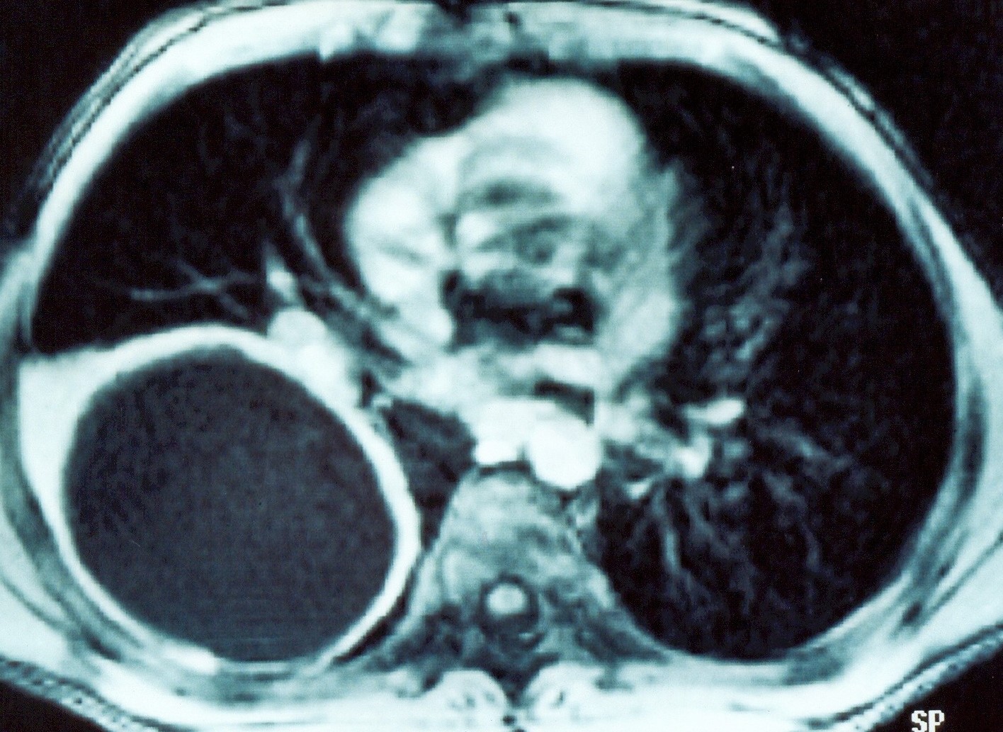 Abdominal computed tomography. Cystic lesion of the right lung. Courtesy Dr. V. Penopoulos.