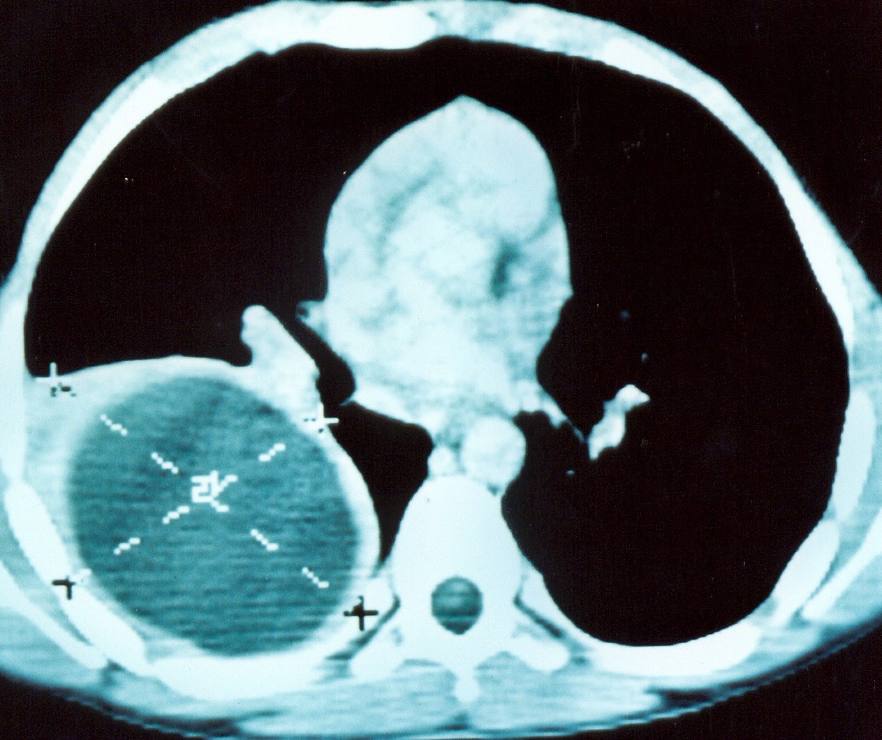 Cystic lesion of the right lobe of the liver. Courtesy Dr. V. Penopoulos.
