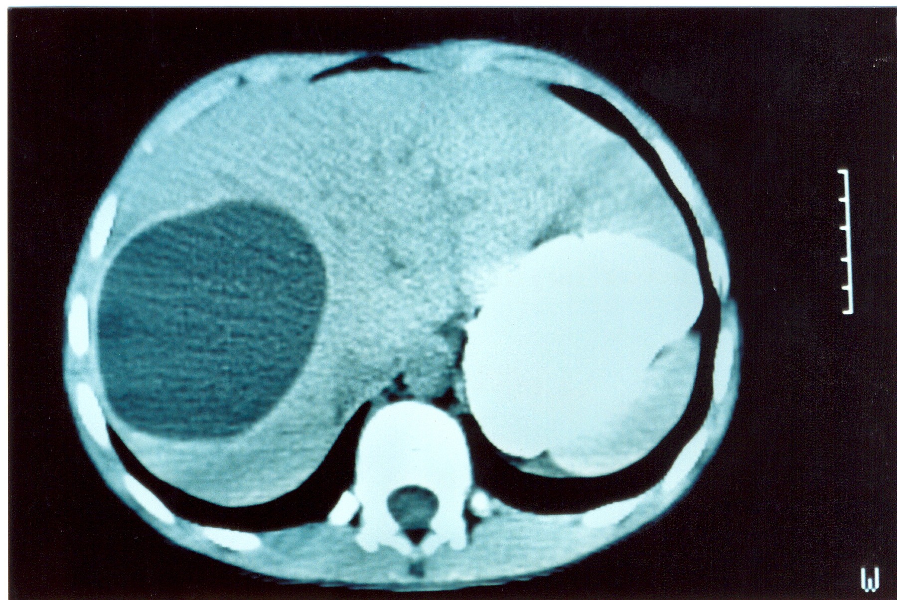 Cystic lesion of the right lobe of the liver. Courtesy Dr. V. Penopoulos.