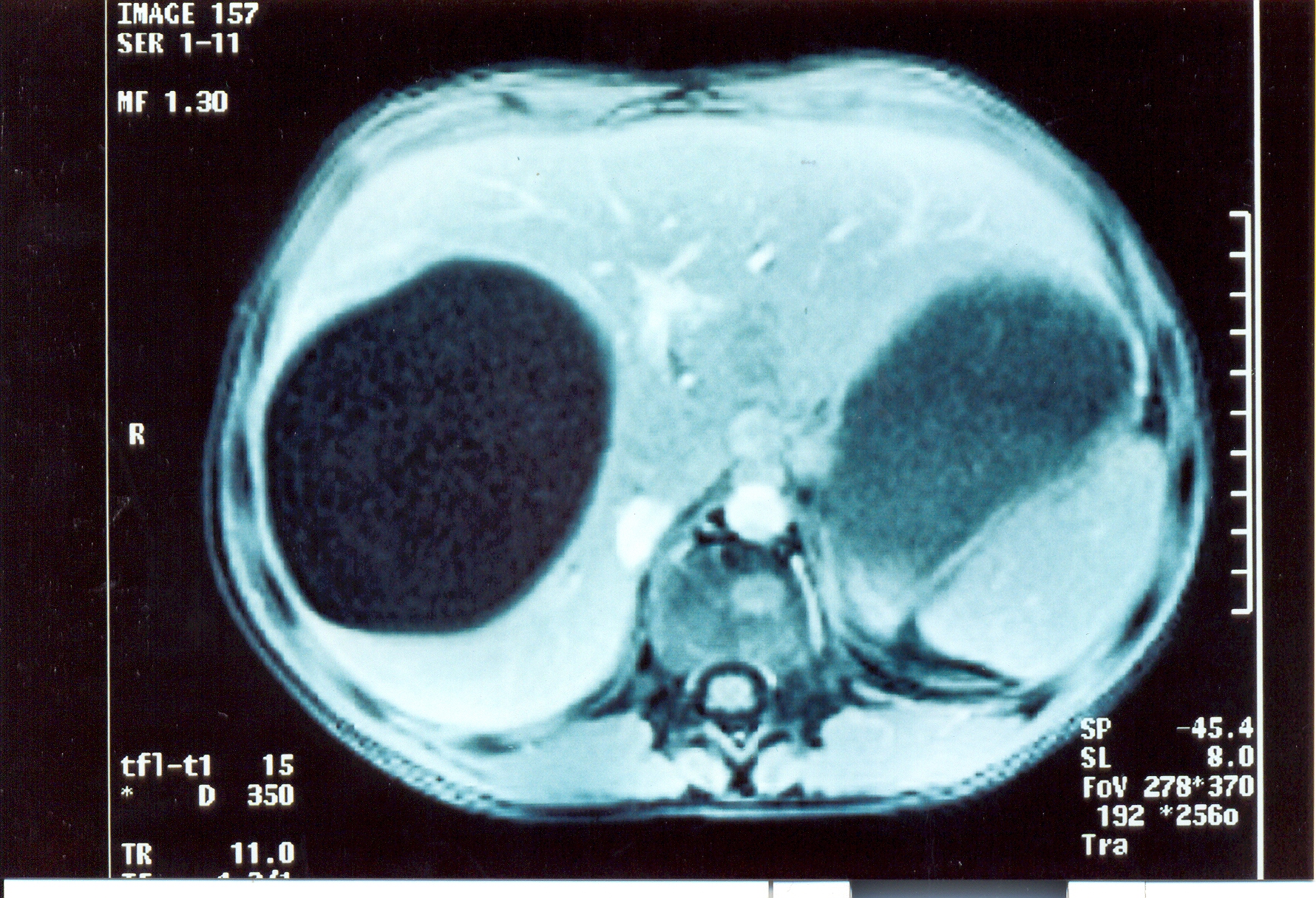 Cystic lesion of the right lobe of the liver. Courtesy Dr. V. Penopoulos.