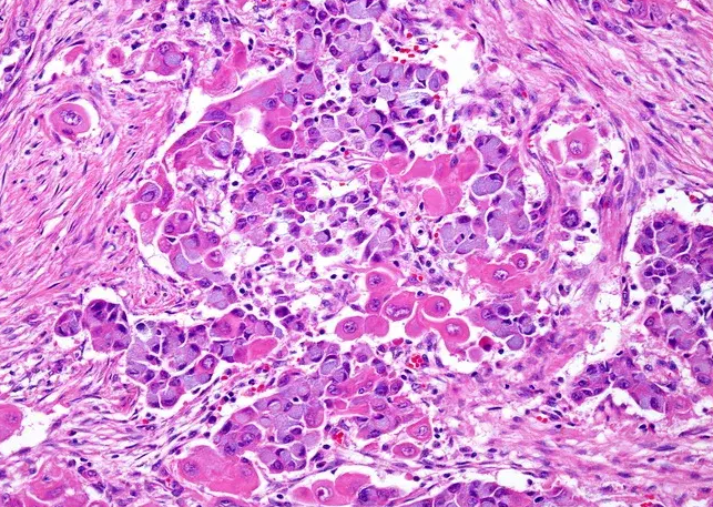 Mucinous cells with blue cytoplasm and flattened nuclei, intermixed with squamous cells containing dense eosinophilic cytoplasm and round nuclei. Courtesy Dr. V. Penopoulos.