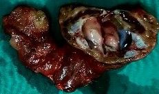 Mucinous cells with blue cytoplasm and flattened nuclei, intermixed with squamous cells containing dense eosinophilic cytoplasm and round nuclei. Courtesy Dr. V. Penopoulos.