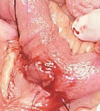 Duodenojejunostomy. Courtesy Dr. V. Penopoulos.