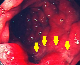 Duodenoscopy. Yellow arrows – Incipient ischemic changes of the third portion of the duodenum due to pressure from the obstruction. Courtesy Dr. V. Penopoulos.