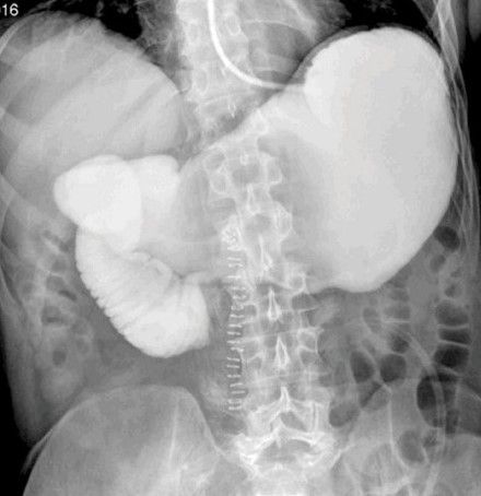 Upper gastrointestinal transit study with gastrografin swallow. Evident obstruction at the third portion of the duodenum. Courtesy Dr. V. Penopoulos.