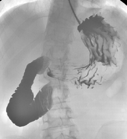 Abdominal computed tomography – Significant gastric and duodenal distension. Obstruction – severe narrowing at the third portion of the duodenum, anterior to the abdominal aorta and posterior to the superior mesenteric artery. Courtesy Dr. V. Penopoulos.