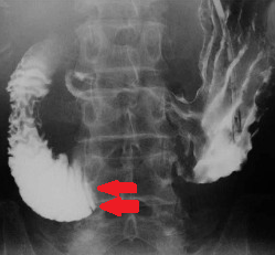 Purple arrow – Stomach. Green arrow – Aorta. Yellow arrow – Distance between the superior mesenteric artery and the aorta. Red arrow – Superior mesenteric artery. Blue arrow – Duodenum. Courtesy Dr. V. Penopoulos.