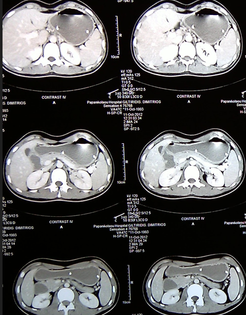CT angiography. Yellow arrow – Aorta. Light blue arrow – Superior mesenteric artery. Pink arrow – Celiac artery (trunk of Haller). Evident significant reduction of the aortomesenteric angle to 9 degrees and the aortomesenteric distance to 4 mm. Courtesy Dr. V. Penopoulos.
