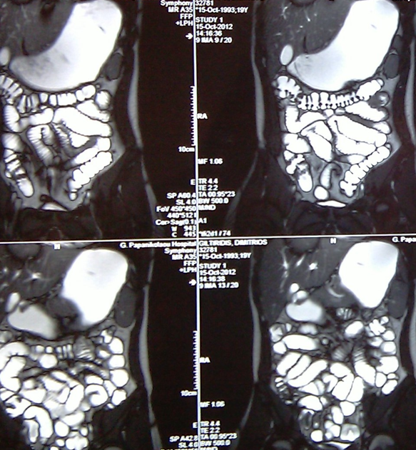 Duodenojejunostomy. Courtesy Dr. V. Penopoulos.
