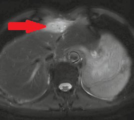 Αξονική τομογραφία κοιλίας – Θρόμβωση αριστερού κλάδου πυλαίας φλέβας. Ευγενική παραχώρηση Dr. V. Penopoulos.
