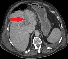 Παροχετευμένη κοιλότητα αποστήματος – αφαίρεση νεκρωτικού υλικού. Ευγενική παραχώρηση Dr. V. Penopoulos.