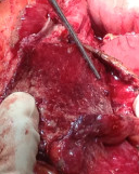 Τμήμα εκτομαθέντος στρογγύλου συνδέσμου. Ευγενική παραχώρηση Dr. V. Penopoulos.