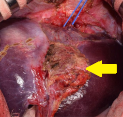 Τμήμα εκτομαθέντος στρογγύλου συνδέσμου. Ευγενική παραχώρηση Dr. V. Penopoulos.