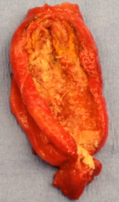 Τμήμα εκτομαθέντος στρογγύλου συνδέσμου. Ευγενική παραχώρηση Dr. V. Penopoulos.