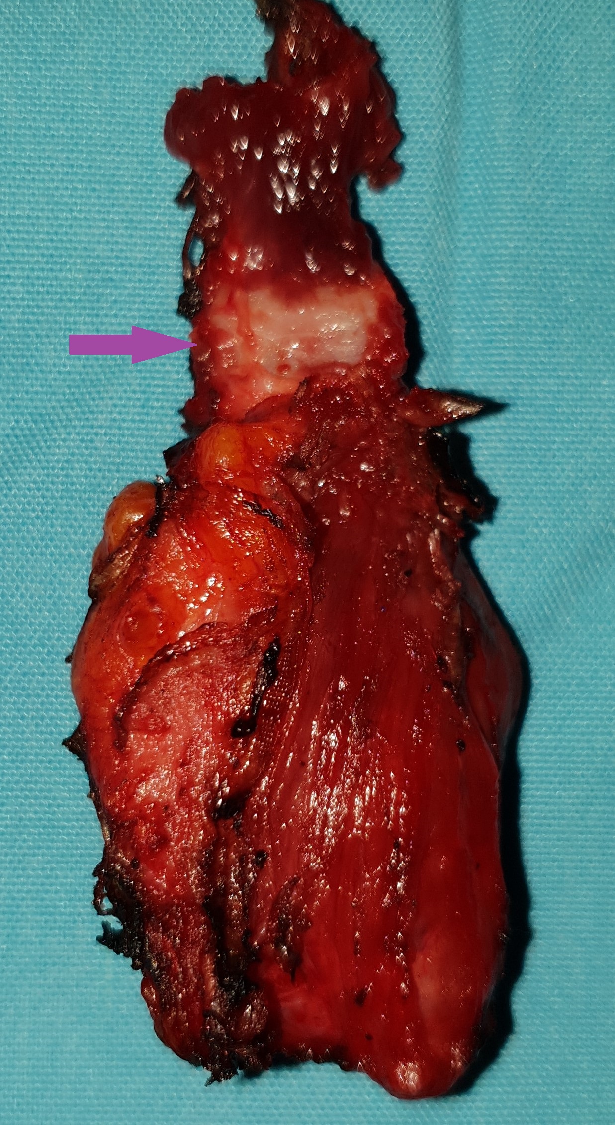 Thyroglossal duct cysts. Neck MRI – Detailed imaging of the cyst. Courtesy Dr. V. Penopoulos.