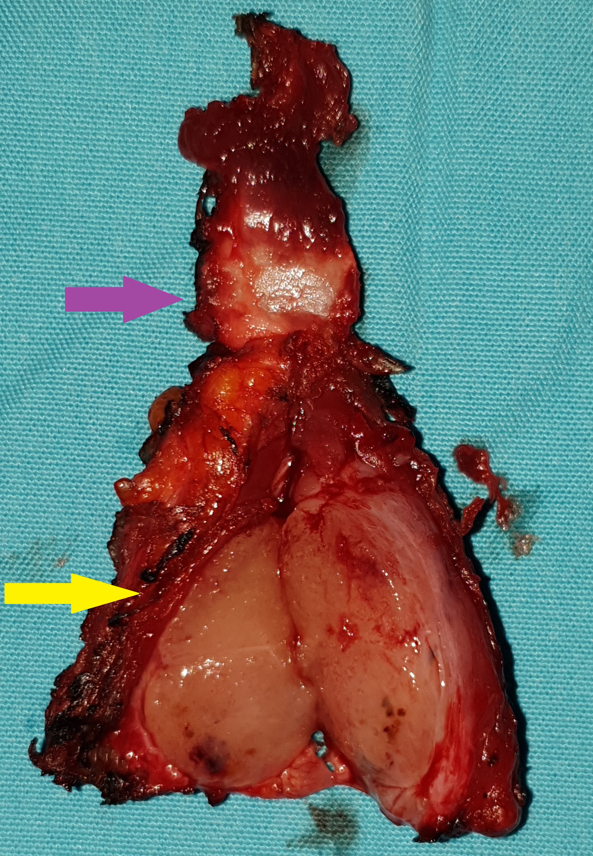 Thyroglossal duct cysts. Neck MRI – Detailed imaging of the cyst. Courtesy Dr. V. Penopoulos.