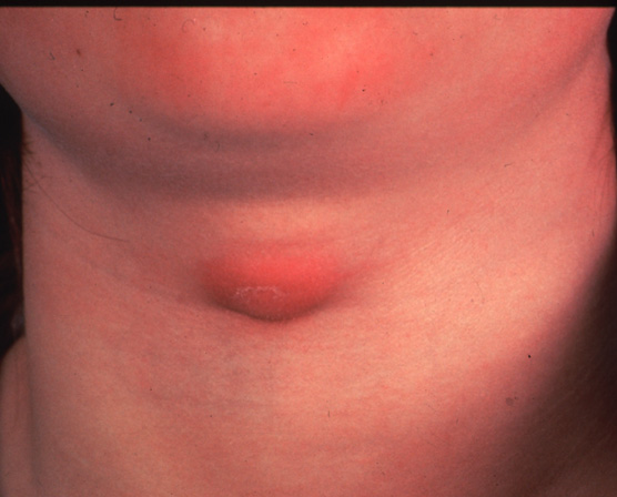 Recurrence of thyroglossal duct cyst. Courtesy Dr. V. Penopoulos.