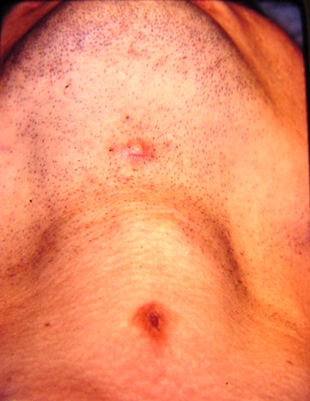 Thyroglossal duct cysts. Neck MRI – Detailed imaging of the cyst. Courtesy Dr. V. Penopoulos.