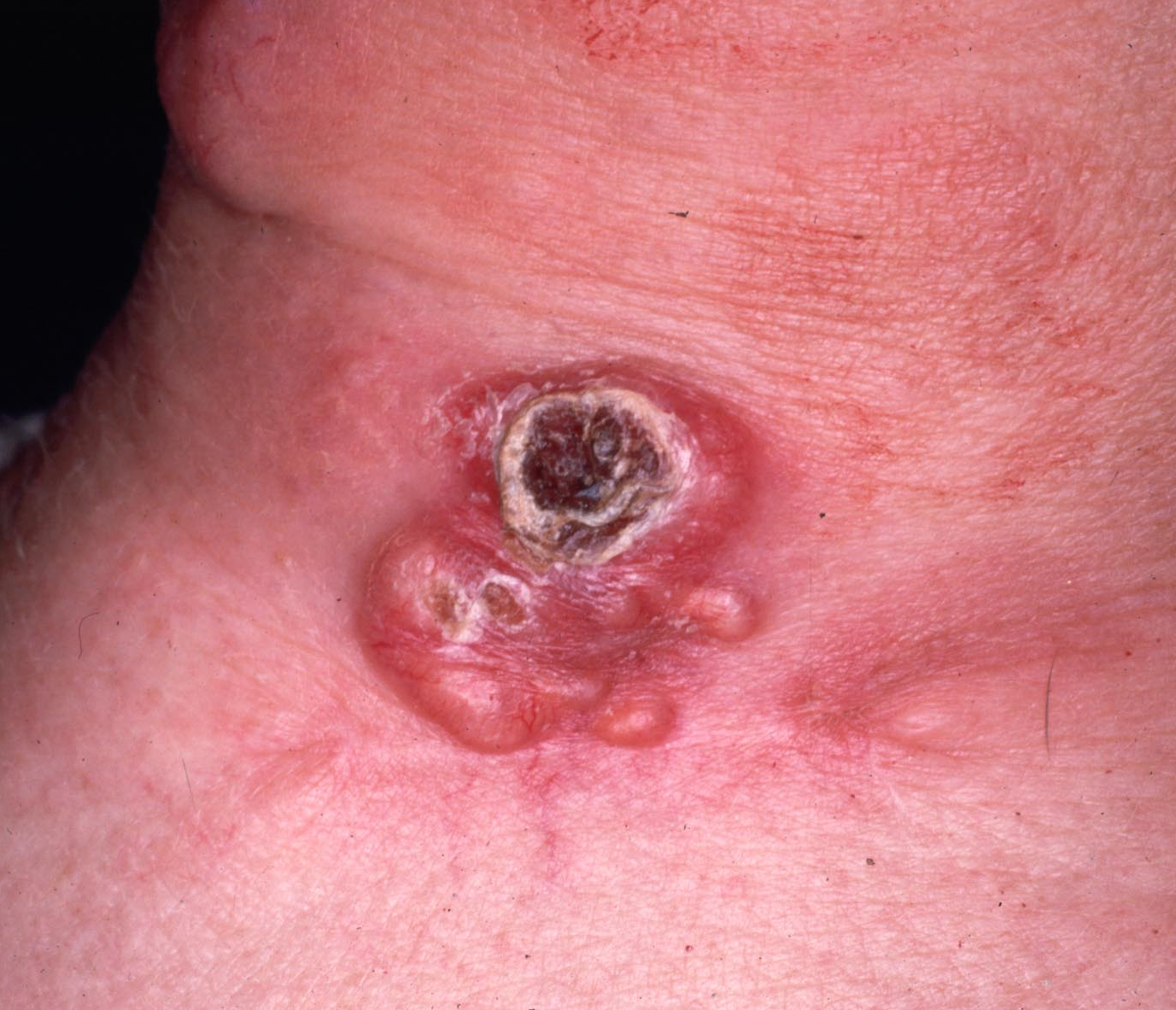 Thyroglossal duct cysts. Neck MRI – Detailed imaging of the cyst. Courtesy Dr. V. Penopoulos.