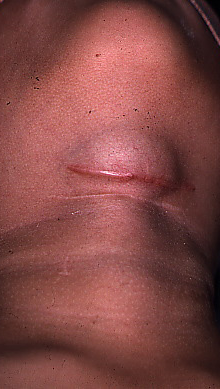 Thyroglossal duct cysts. Neck MRI – Detailed imaging of the cyst. Courtesy Dr. V. Penopoulos.