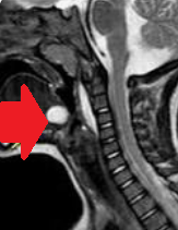 Thyroglossal duct cysts. Neck MRI – Detailed imaging of the cyst. Courtesy Dr. V. Penopoulos.