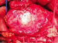 Intraoperative image of retroperitoneal neoplasm (Courtesy Dr. V. Penopoulos)