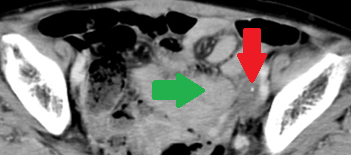 Abdominal CT scan after 2 years. Red arrow - Small residual neoplasm. Green arrow - Small bowel loops (Courtesy Dr. V. Penopoulos)