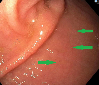 Μετεγχειρητικές βιοψίες ειλεϊκής ταύτης - Προσαρμογή ταύτης (Ευγενική παραχώρηση Dr. V. Penopoulos)