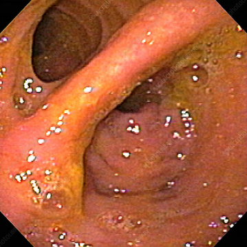 Μετεγχειρητικές βιοψίες ειλεϊκής ταύτης - Προσαρμογή ταύτης (Ευγενική παραχώρηση Dr. V. Penopoulos)