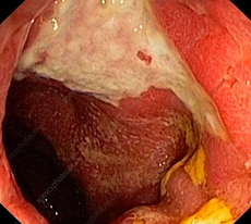 Μετεγχειρητικές βιοψίες ειλεϊκής ταύτης - Προσαρμογή ταύτης (Ευγενική παραχώρηση Dr. V. Penopoulos)