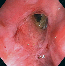 Μετεγχειρητικές βιοψίες ειλεϊκής ταύτης - Προσαρμογή ταύτης (Ευγενική παραχώρηση Dr. V. Penopoulos)