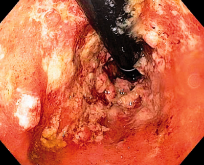 Μετεγχειρητικές βιοψίες ειλεϊκής ταύτης - Προσαρμογή ταύτης (Ευγενική παραχώρηση Dr. V. Penopoulos)