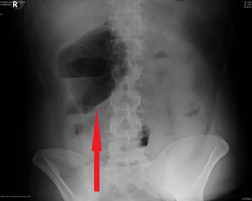 Απλή ακτινογραφία κοιλίας. Διάταση ειλεϊκής ταύτης και μετατόπισή της στη δεξιά πλευρά της κοιλίας (Ευγενική παραχώρηση Dr. V. Penopoulos)