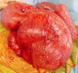 Διεγχειρητική εικόνα χρόνια φλεγμαίνουσας, διατεταμένης, δυσλειτουργικής ταύτης με συνοδό διάταση εγγύτερων ελίκων λεπτού εντέρου (Ευγενική παραχώρηση Dr. V. Penopoulos)