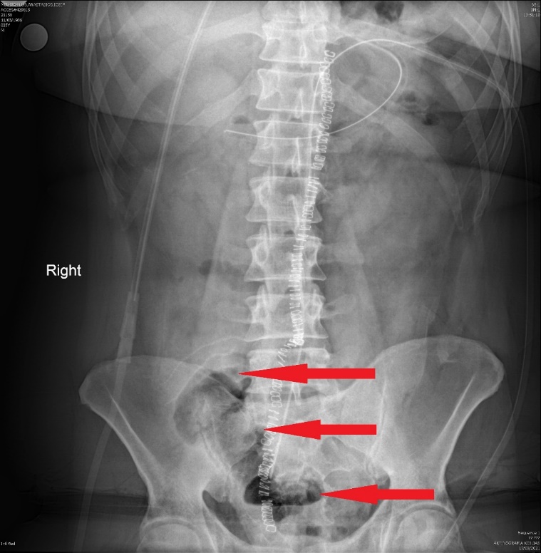Η πλήρως αποσυμπιεσμένη ταύτη στην πύελο (Ευγενική παραχώρηση Dr. V. Penopoulos)