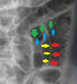 Απλή ακτινογραφία κοιλίας - Πολύχρωμα βέλη - Σημείο Rigler (Ευγενική παραχώρηση Dr. V. Penopoulos)
