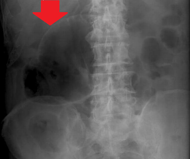Απλή ακτινογραφία κοιλίας - Πολύχρωμα βέλη - Σημείο Rigler (Ευγενική παραχώρηση Dr. V. Penopoulos)