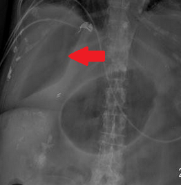 Απλή ακτινογραφία κοιλίας. Σημείο υπερδιαυγαστικού ήπατος (Ευγενική παραχώρηση Dr. V. Penopoulos)